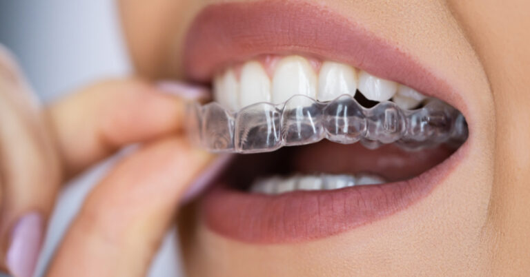 capa invisalign