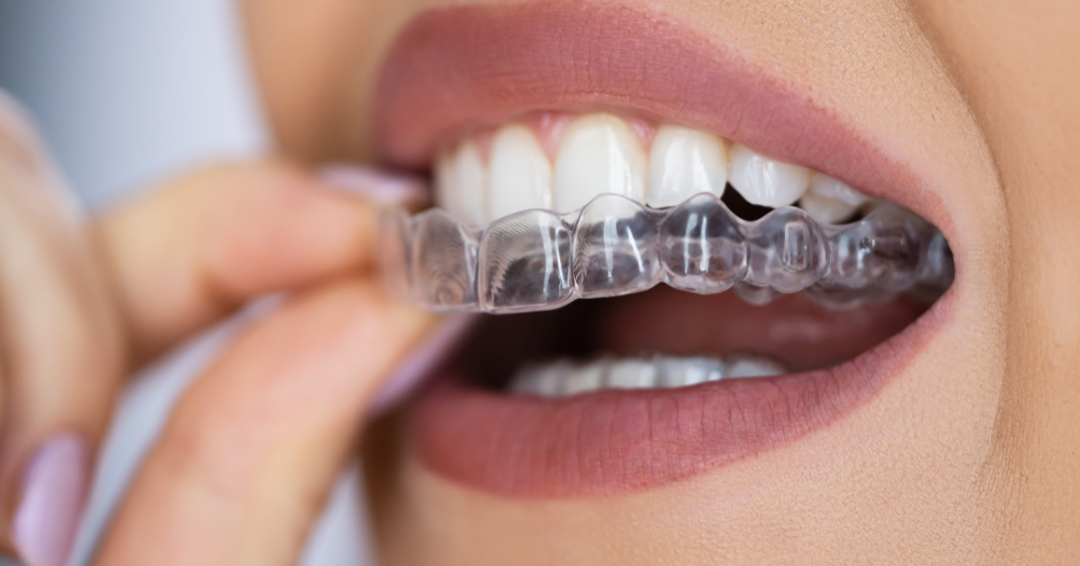 invisalign em cidade