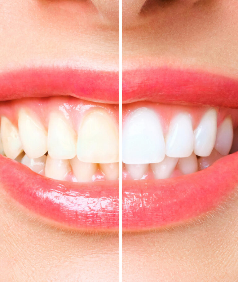 clareamento dental antes e depois